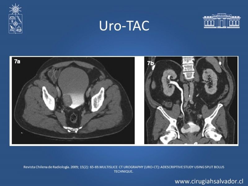 Diapositiva 14 de Hematuria: Hematuria-Urológica-Urgencias
