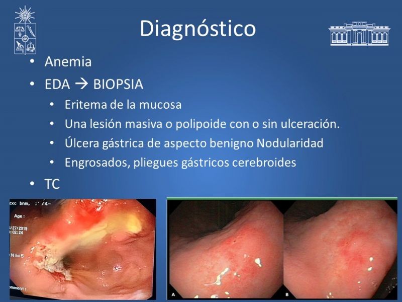 Diapositiva 18 de Caso Clínico: Linfoma Gástrico