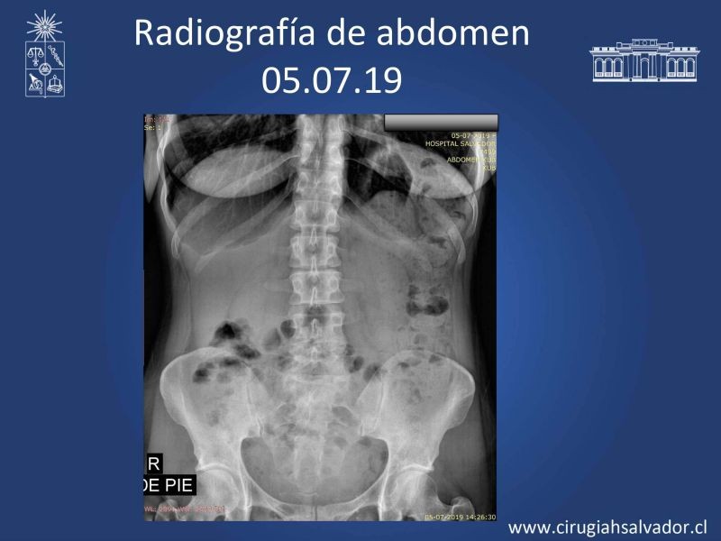 Diapositiva 19 de Caso Clínico: vólvulo sigmoides