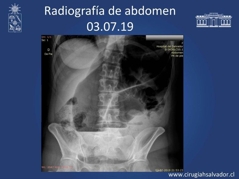 Diapositiva 11 de Caso Clínico: vólvulo sigmoides