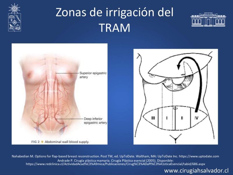 Diapositiva 17 de Reconstrucción mamaria