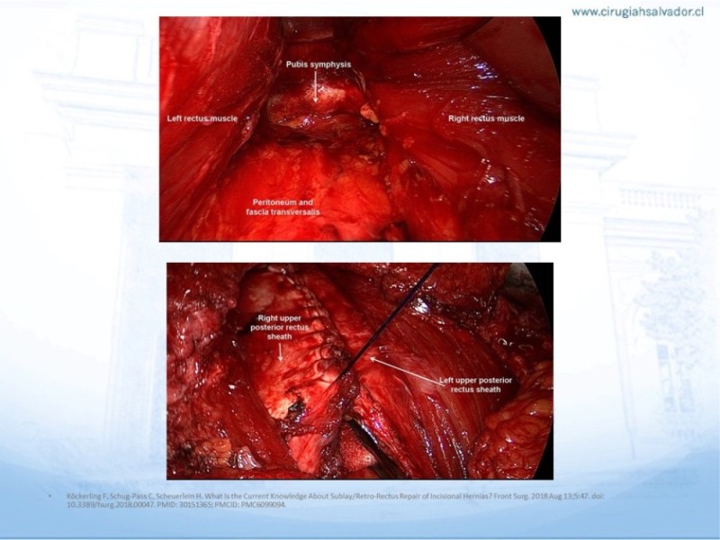 Diapositiva 15 de Posición de malla en hernias: Onlay, Inley, Subley