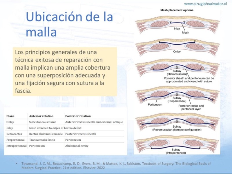 Diapositiva 10 de Posición de malla en hernias: Onlay, Inley, Subley