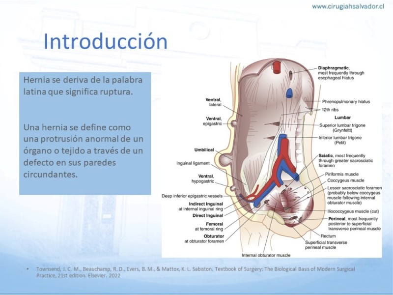Diapositiva 2 de Posición de malla en hernias: Onlay, Inley, Subley