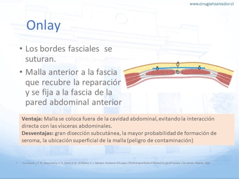 Diapositiva 11 de Posición de malla en hernias: Onlay, Inley, Subley