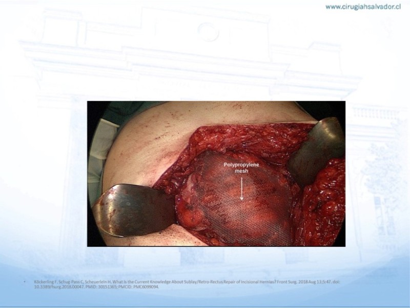 Diapositiva 16 de Posición de malla en hernias: Onlay, Inley, Subley