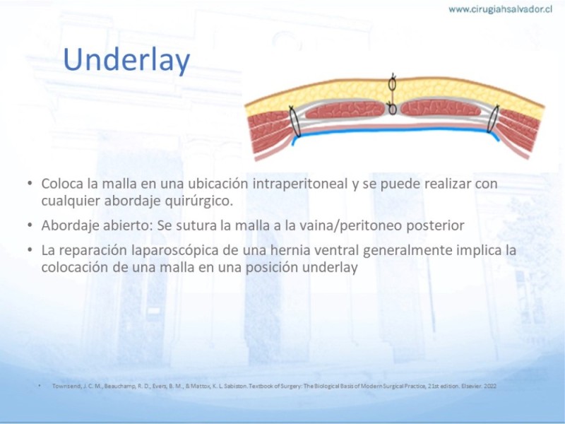 Diapositiva 17 de Posición de malla en hernias: Onlay, Inley, Subley
