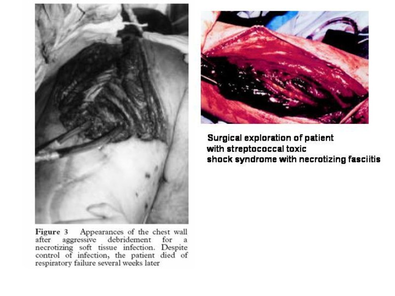 Diapositiva 21 de Fasceitis necrotizante
