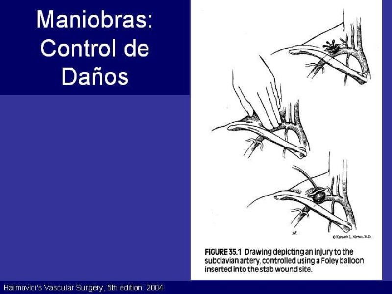 Diapositiva 34 de Trauma Cervical Penetrante