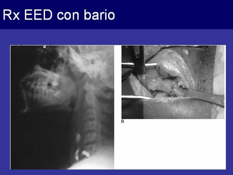Diapositiva 17 de Trauma Cervical Penetrante