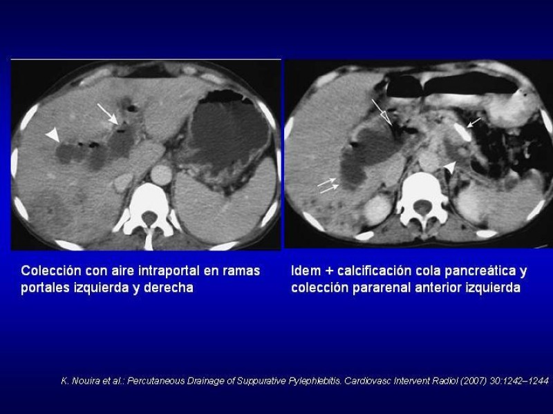 Diapositiva 21 de Pileflebitis
