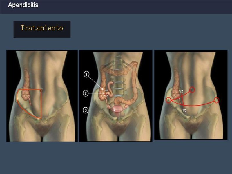 Diapositiva 25 de Apendicitis