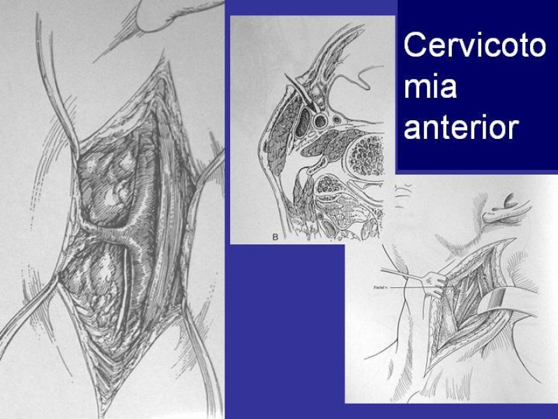 Diapositiva 41 de Trauma Cervical Penetrante