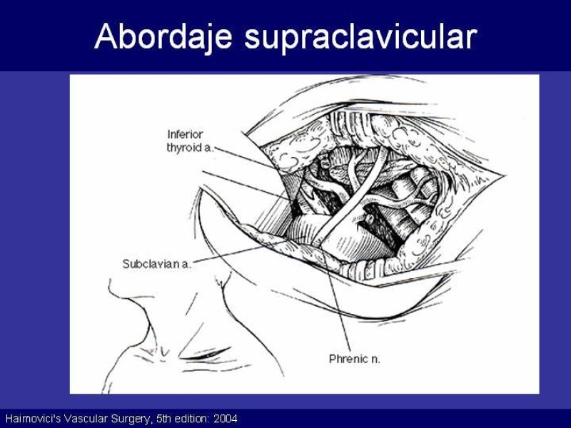 Diapositiva 44 de Trauma Cervical Penetrante