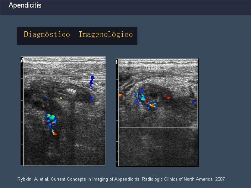 Diapositiva 19 de Apendicitis