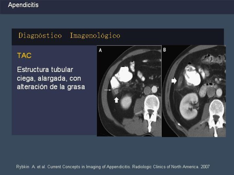 Diapositiva 20 de Apendicitis