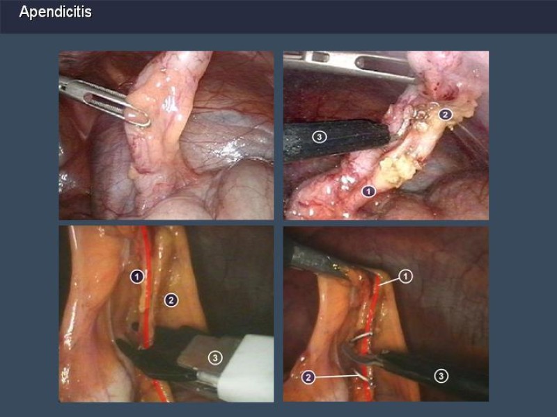 Diapositiva 29 de Apendicitis