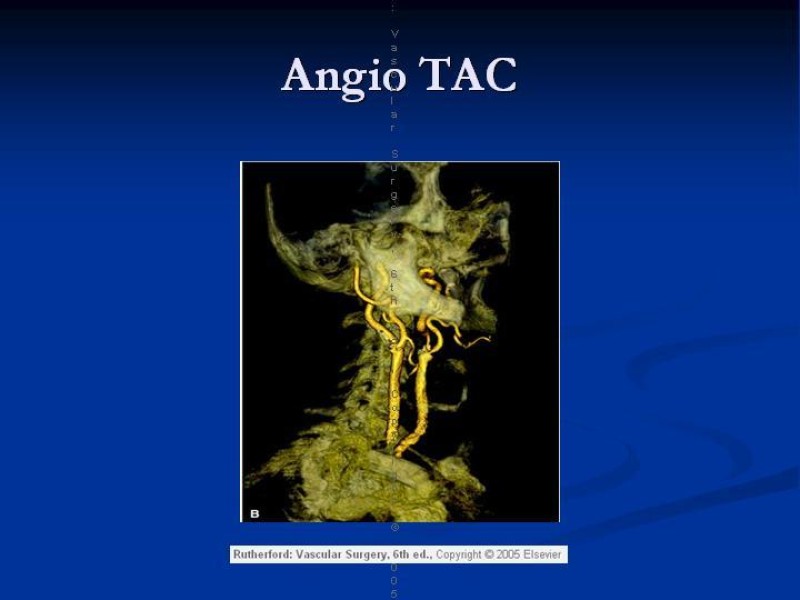 Diapositiva 8 de Estenosis Carotidea Endarterectomía y Angioplastía
