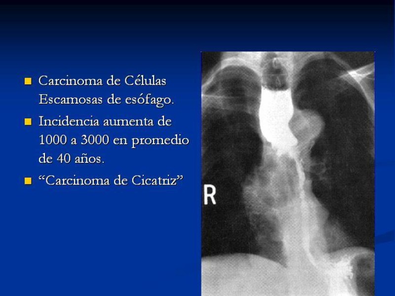 Diapositiva 26 de Lesiones Esofágicas por Cáusticos