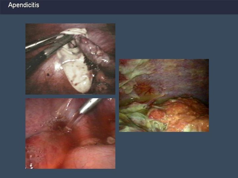 Diapositiva 31 de Apendicitis