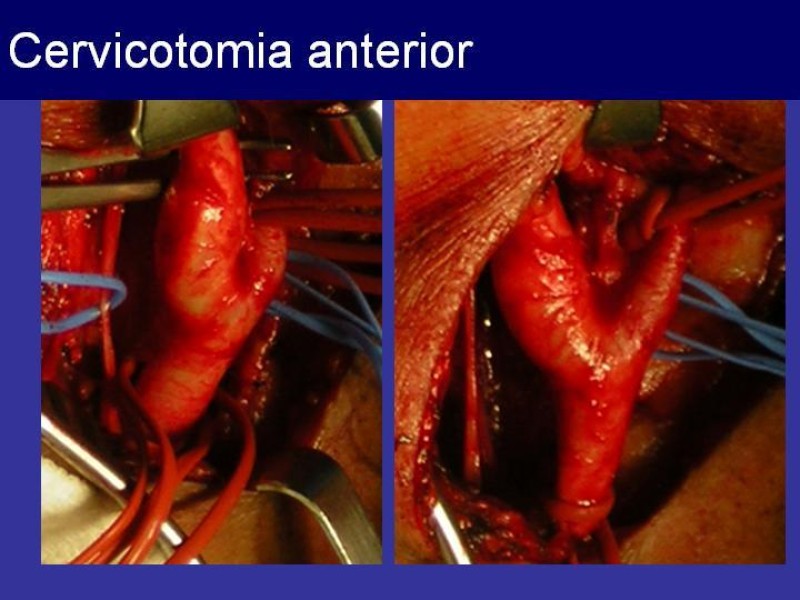Diapositiva 43 de Trauma Cervical Penetrante