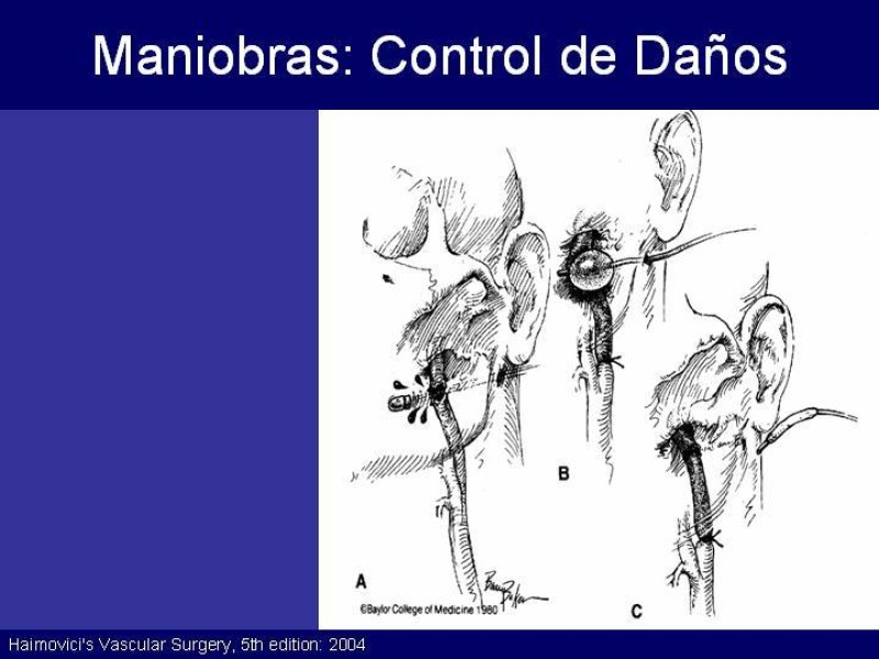 Diapositiva 35 de Trauma Cervical Penetrante