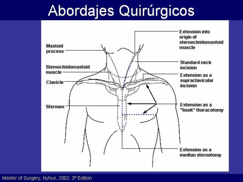 Diapositiva 36 de Trauma Cervical Penetrante