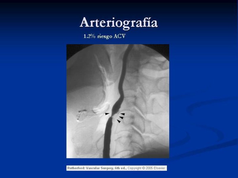 Diapositiva 6 de Estenosis Carotidea Endarterectomía y Angioplastía
