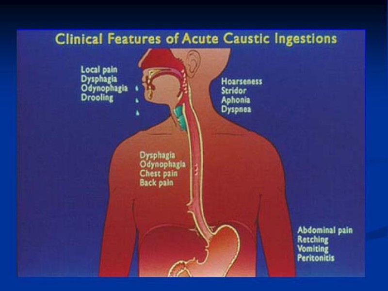 Diapositiva 11 de Lesiones Esofágicas por Cáusticos