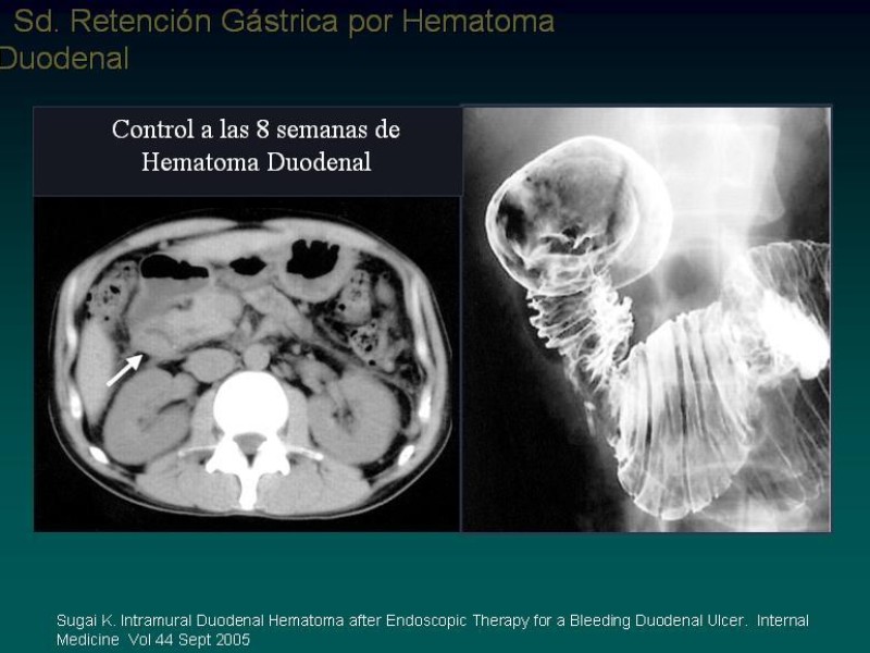 Diapositiva 13 de Síndrome Retención Gástrica