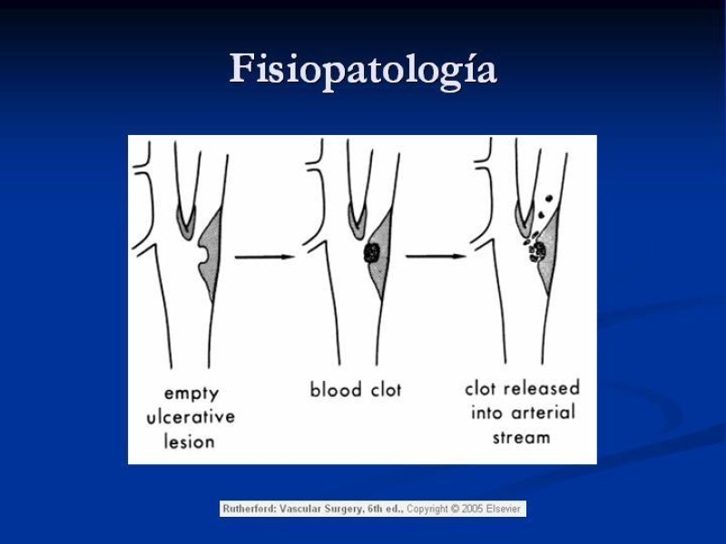 Diapositiva 4 de Estenosis Carotidea Endarterectomía y Angioplastía
