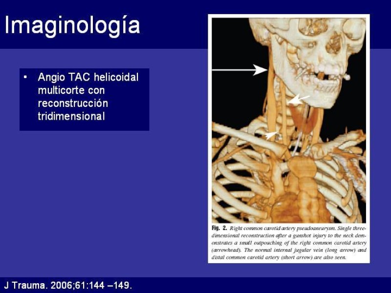 Diapositiva 18 de Trauma Cervical Penetrante