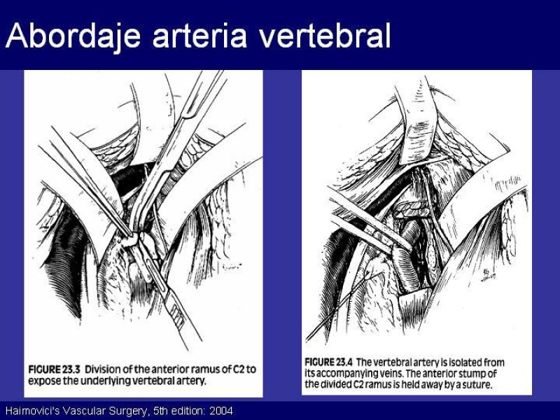 Diapositiva 49 de Trauma Cervical Penetrante