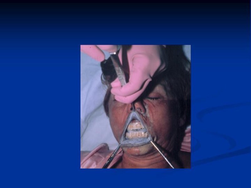 Diapositiva 12 de Lesiones Esofágicas por Cáusticos