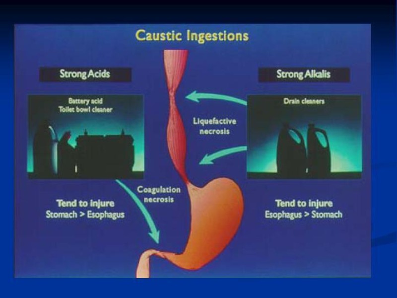 Diapositiva 6 de Lesiones Esofágicas por Cáusticos