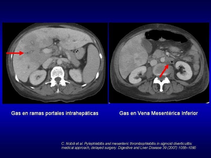 Diapositiva 13 de Pileflebitis