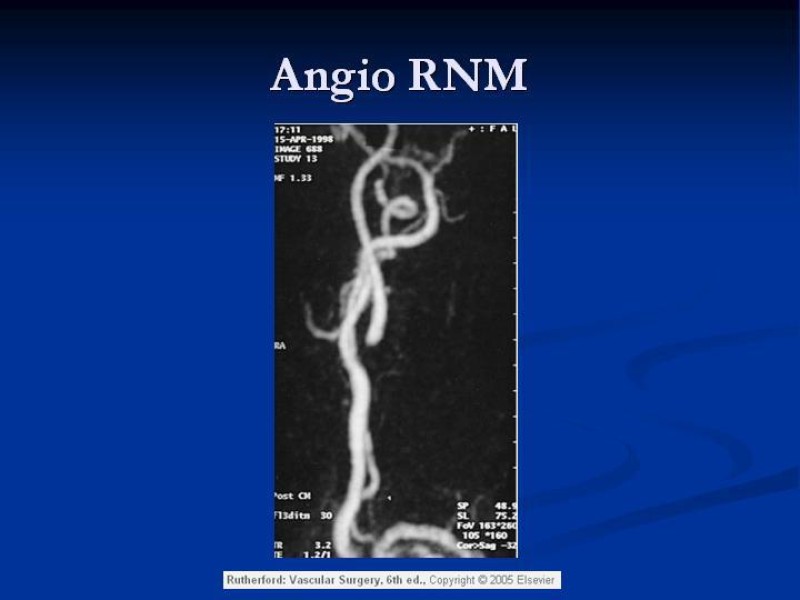 Diapositiva 9 de Estenosis Carotidea Endarterectomía y Angioplastía