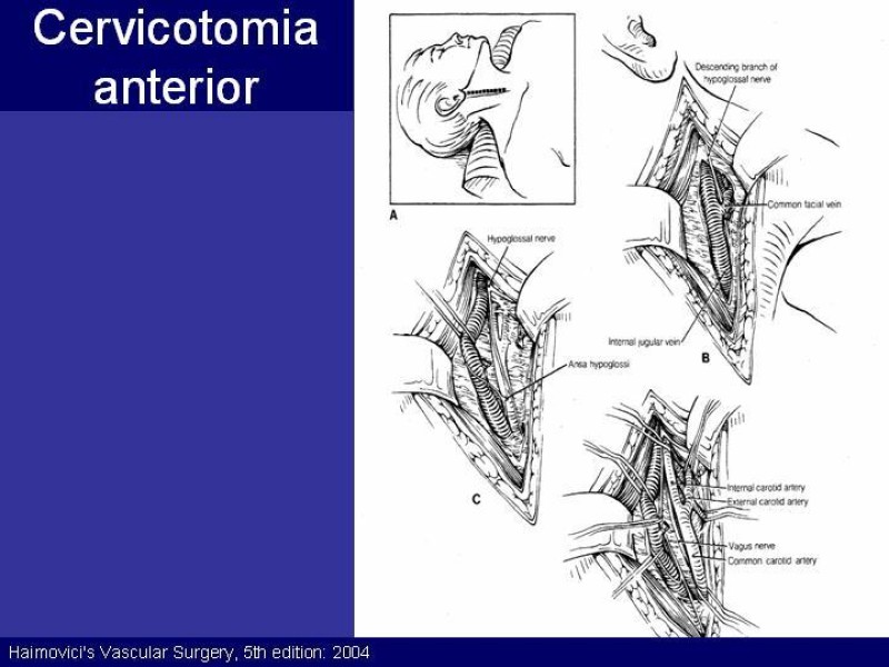 Diapositiva 37 de Trauma Cervical Penetrante