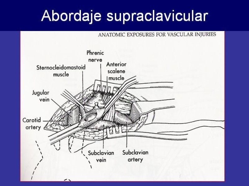 Diapositiva 46 de Trauma Cervical Penetrante