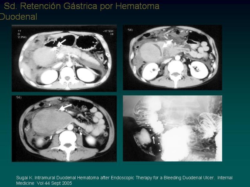 Diapositiva 12 de Síndrome Retención Gástrica