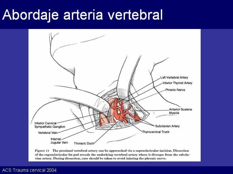 Diapositiva 51 de Trauma Cervical Penetrante
