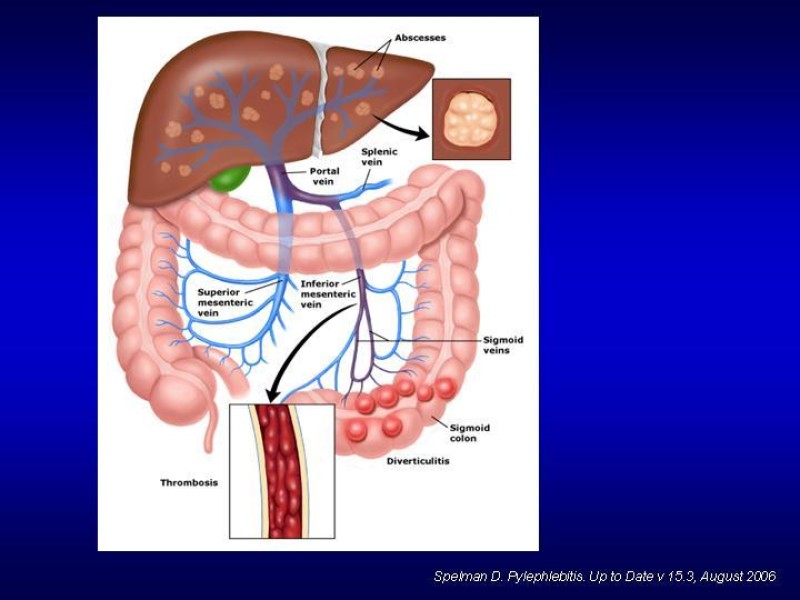 Diapositiva 4 de Pileflebitis
