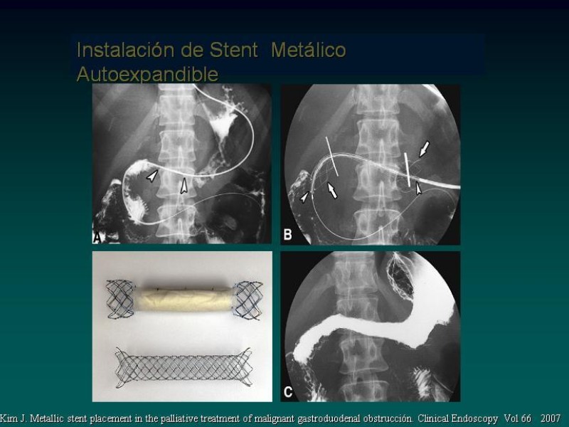 Diapositiva 23 de Síndrome Retención Gástrica