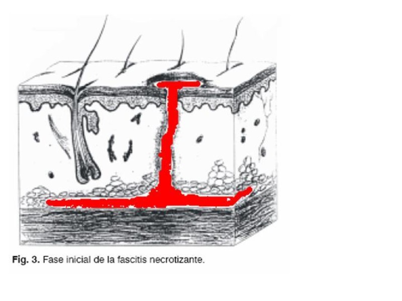 Diapositiva 7 de Fasceitis necrotizante