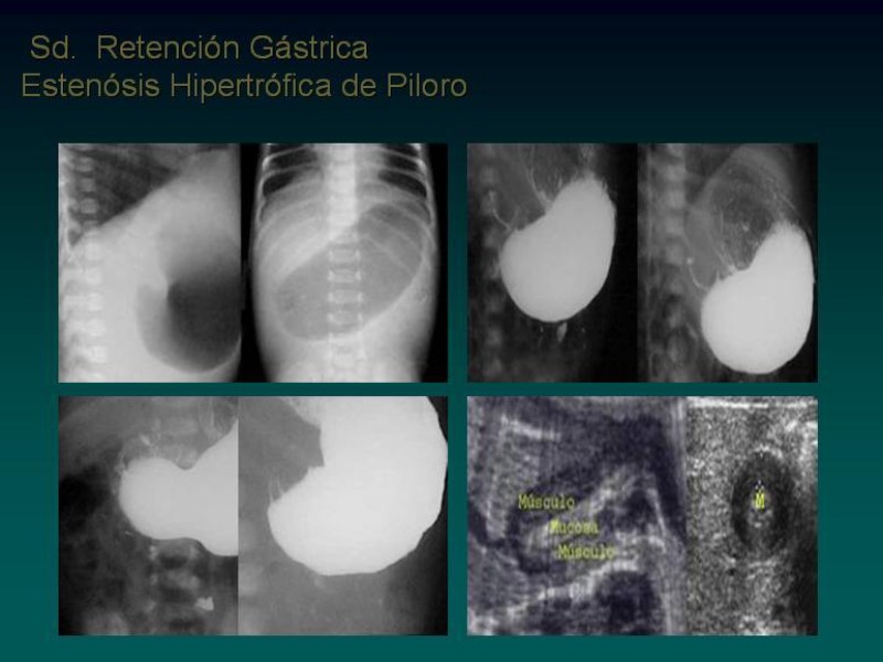 Diapositiva 7 de Síndrome Retención Gástrica