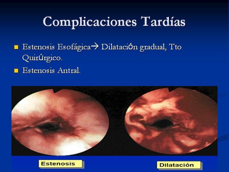 Diapositiva 24 de Lesiones Esofágicas por Cáusticos