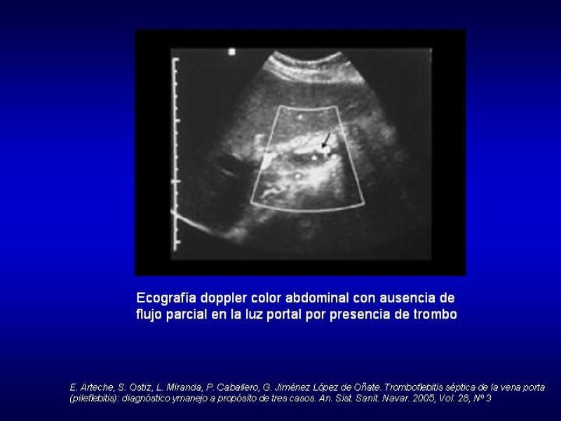 Diapositiva 11 de Pileflebitis