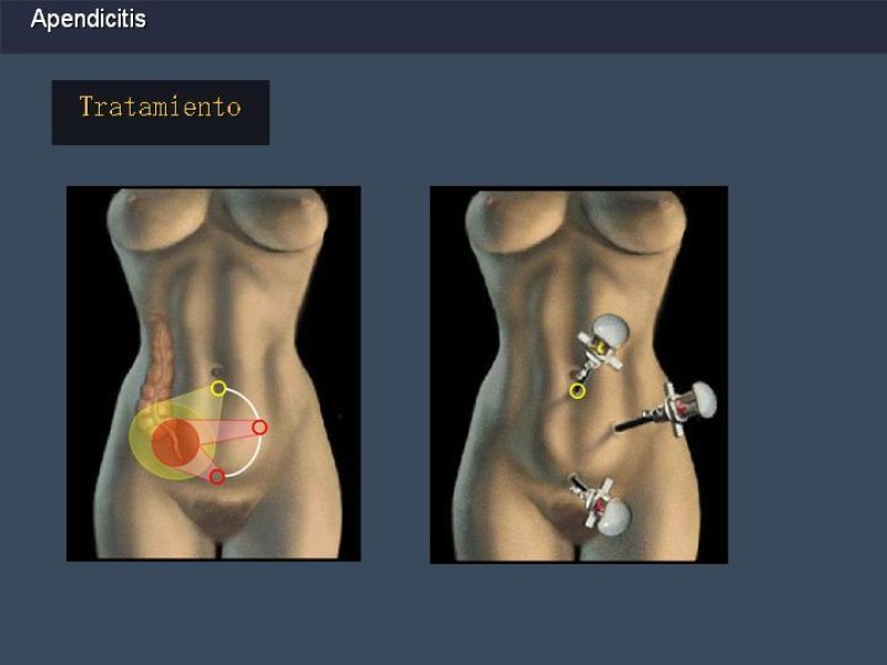 Diapositiva 28 de Apendicitis