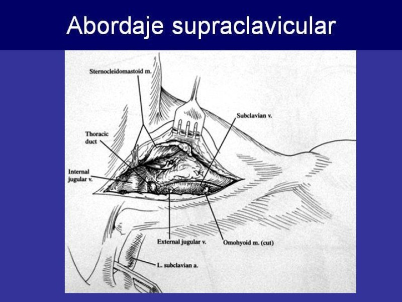 Diapositiva 45 de Trauma Cervical Penetrante