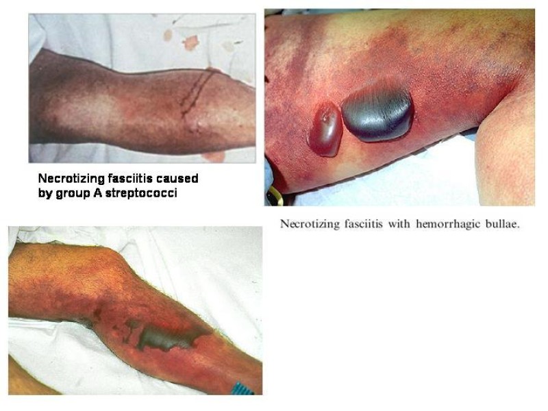 Diapositiva 11 de Fasceitis necrotizante